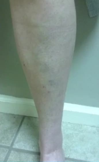 The same lower leg after treatment, with the raised veins no longer visible