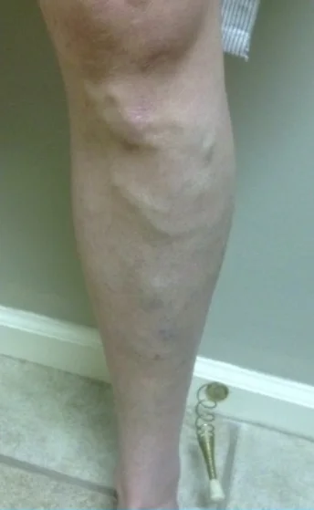A patient’s lower leg before varicose vein treatment, with raised, twisted veins visible along the calf