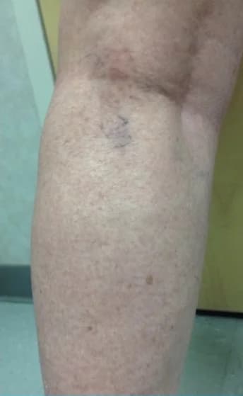 The same leg after treatment, with the cluster of fine veins cleared