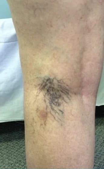 A patient’s leg before spider vein treatment, with a dark cluster of fine veins behind the knee