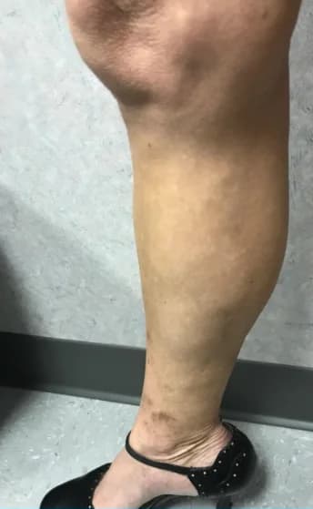 The same calf after treatment, with the surface veins reduced