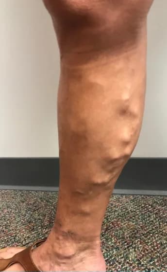 A patient’s calf before varicose vein treatment, with prominent surface veins