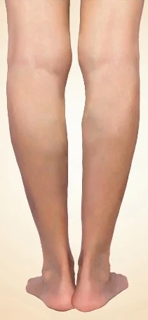 Spider veins on the lower legs