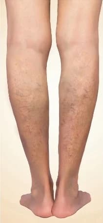 Reticular varicose veins on the lower legs
