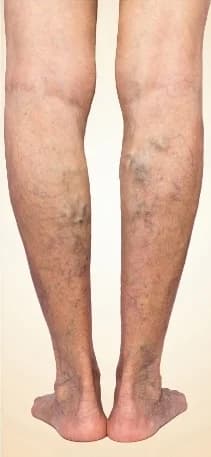 Bulging venous nodes on the lower legs