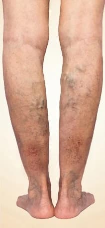 Skin changes and swelling from venous insufficiency