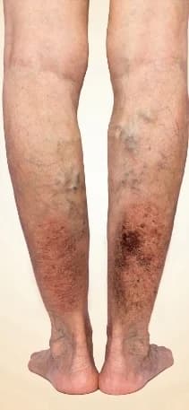 A venous ulcer on the lower leg