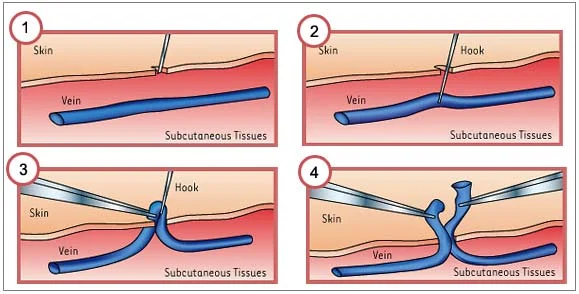 Ambulatory phlebectomy instruments used to remove small varicose veins