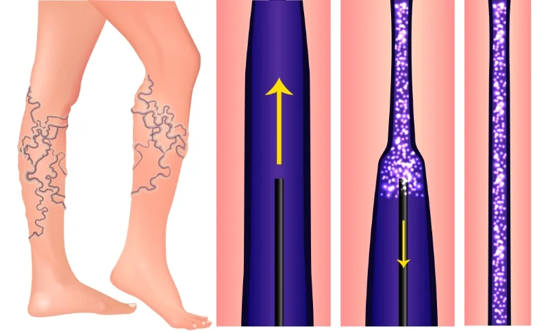 Sclerotherapy injection treating veins in the leg