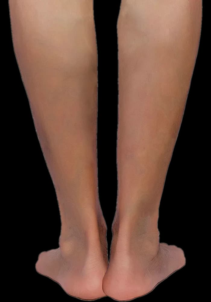 Lower legs at the earliest stage of venous disease — the skin is still clear, with no prominent surface veins