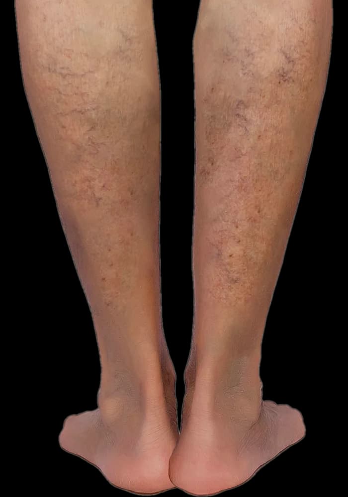 Fine, web-like spider veins visible across the back of both lower legs
