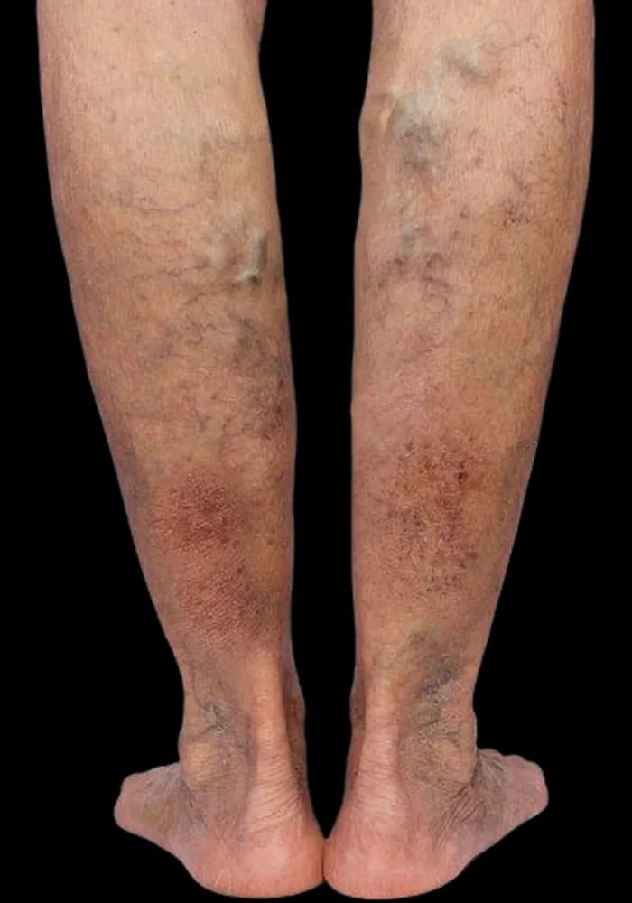 Reddish-brown discoloration developing over the lower legs and ankles, with dense surface veins beneath