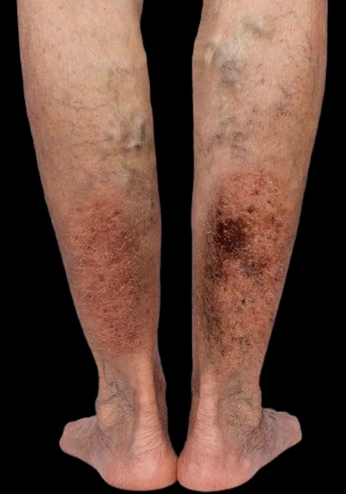 Advanced venous skin change — dark hyperpigmentation and thickened skin across the lower legs and ankles